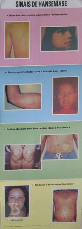 Sinais de hanseníase